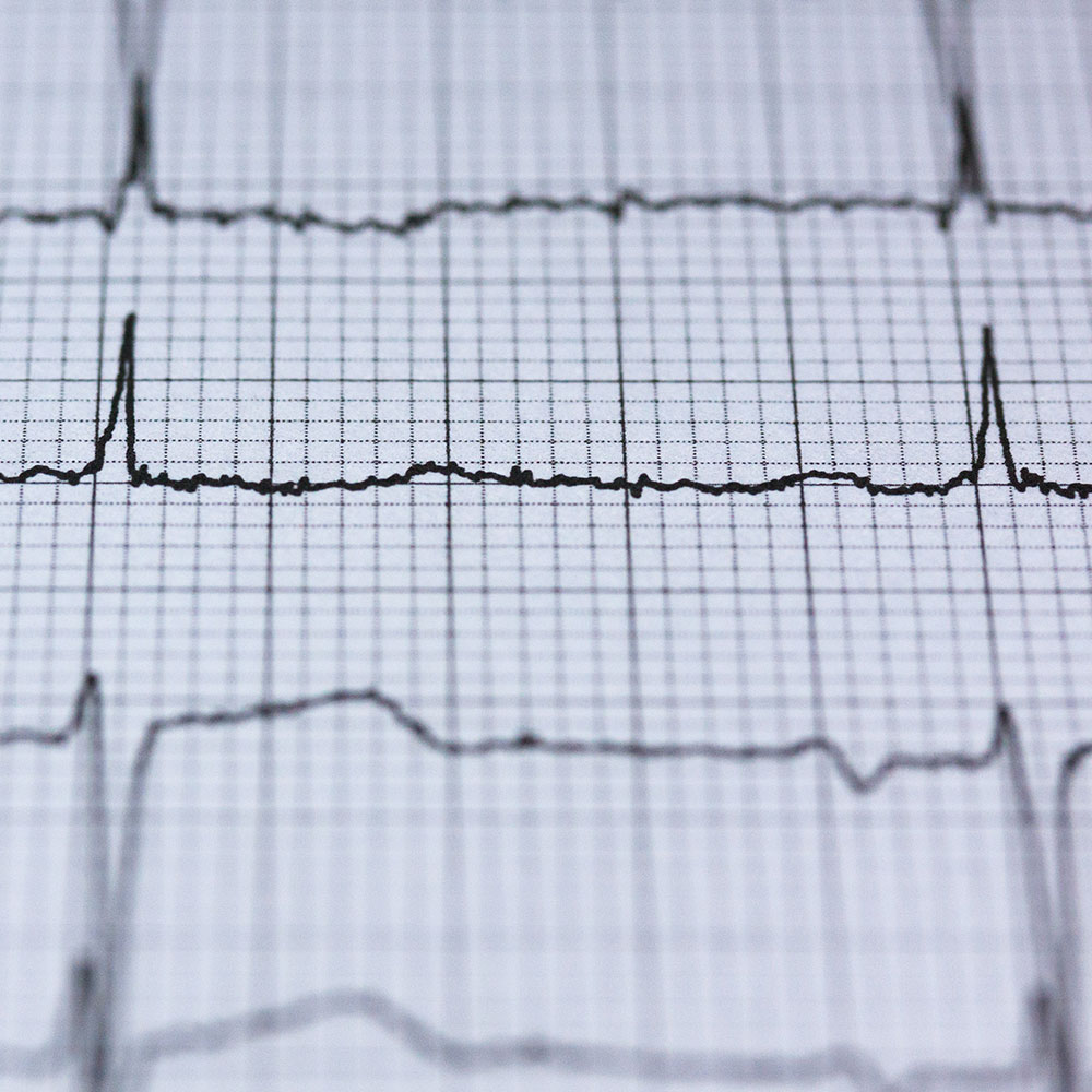 Ein Ausschnitt eines EKG-Blattes